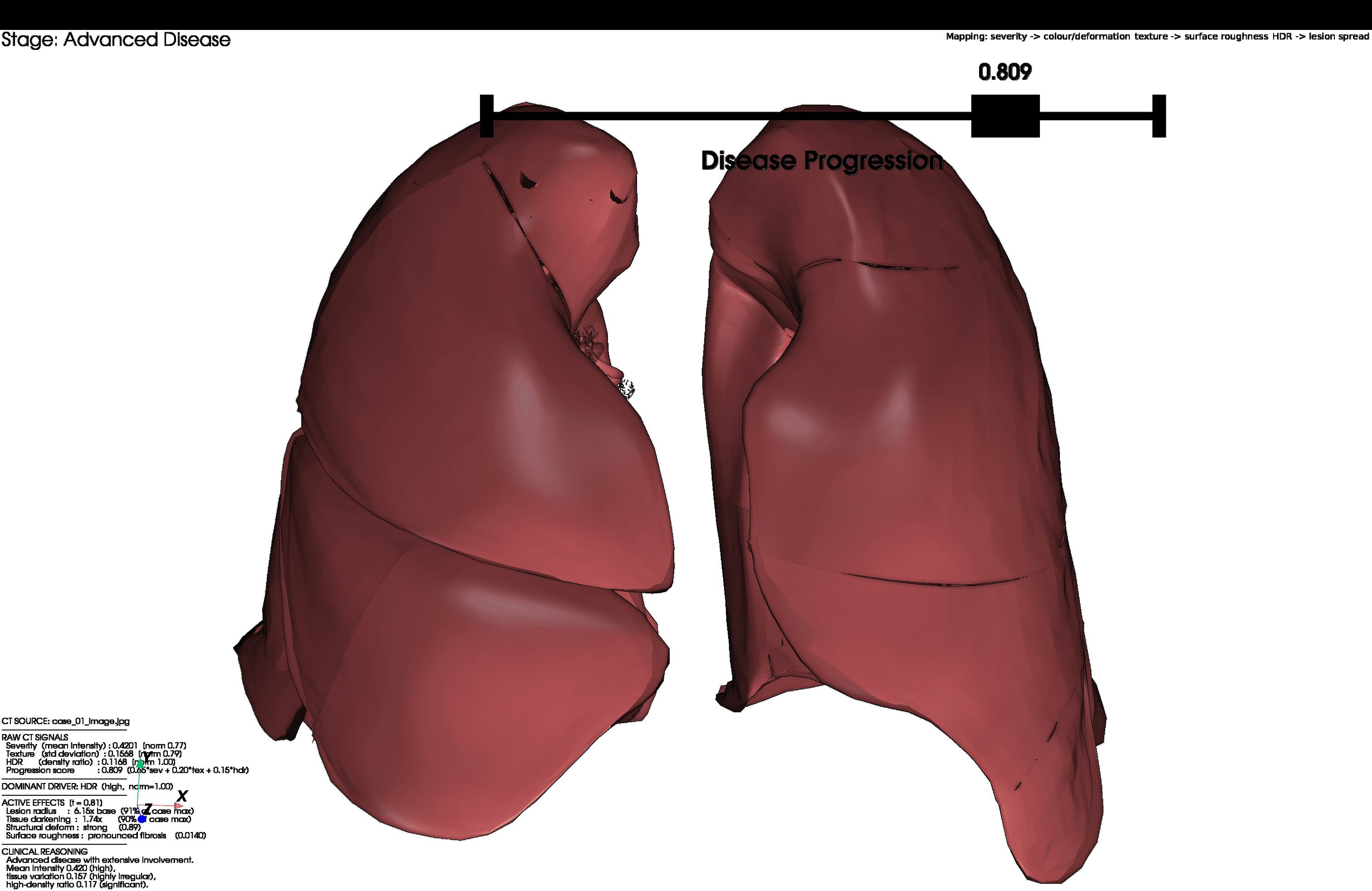 3D lung mesh rendered by the pipeline for Case 01: advanced disease, progression score 0.809, deep fibrotic red with strong deformation