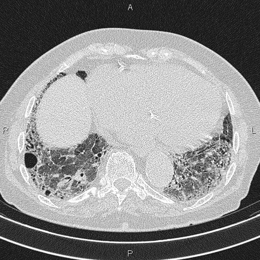 Raw axial chest CT slice for Case 01 showing extensive honeycombing and fibrosis
