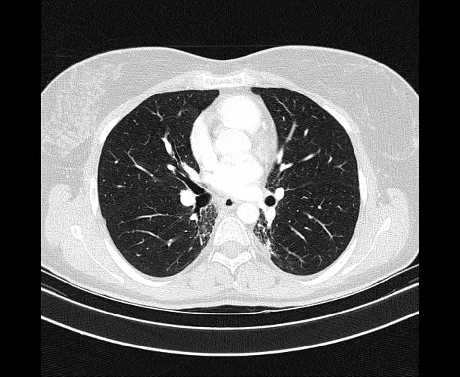 Raw axial chest CT slice for Case 08 showing clear lung fields