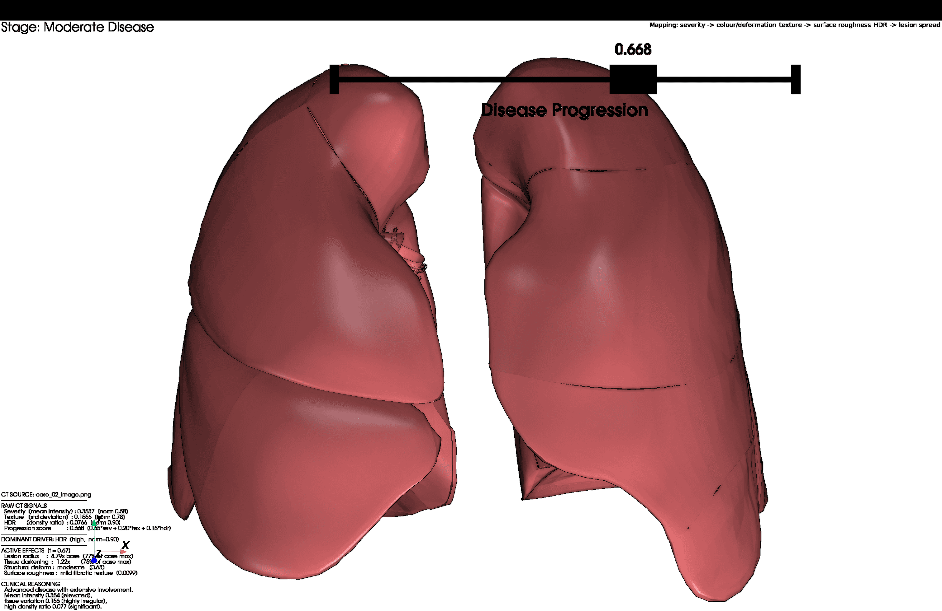 3D lung render for Case 02, progression score 0.668, moderate disease