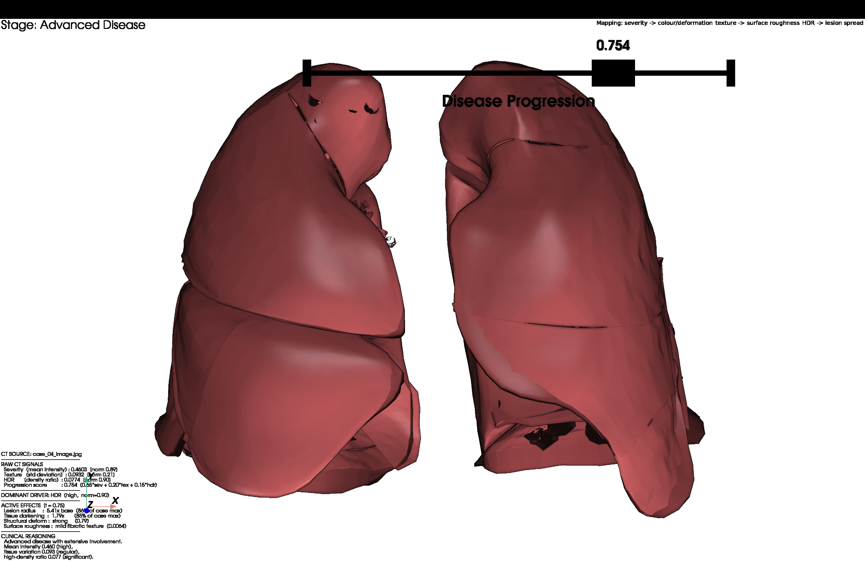 3D lung render for Case 04, progression score 0.754, advanced disease with strong deformation